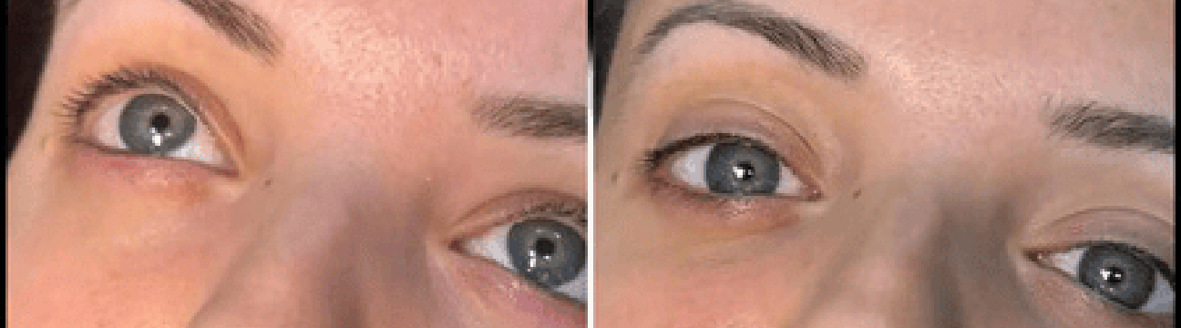Dermal Fillers